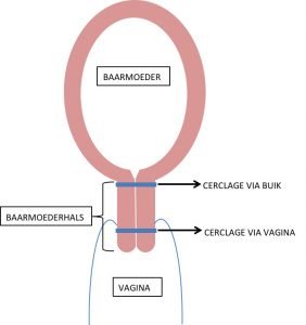 Cerclage